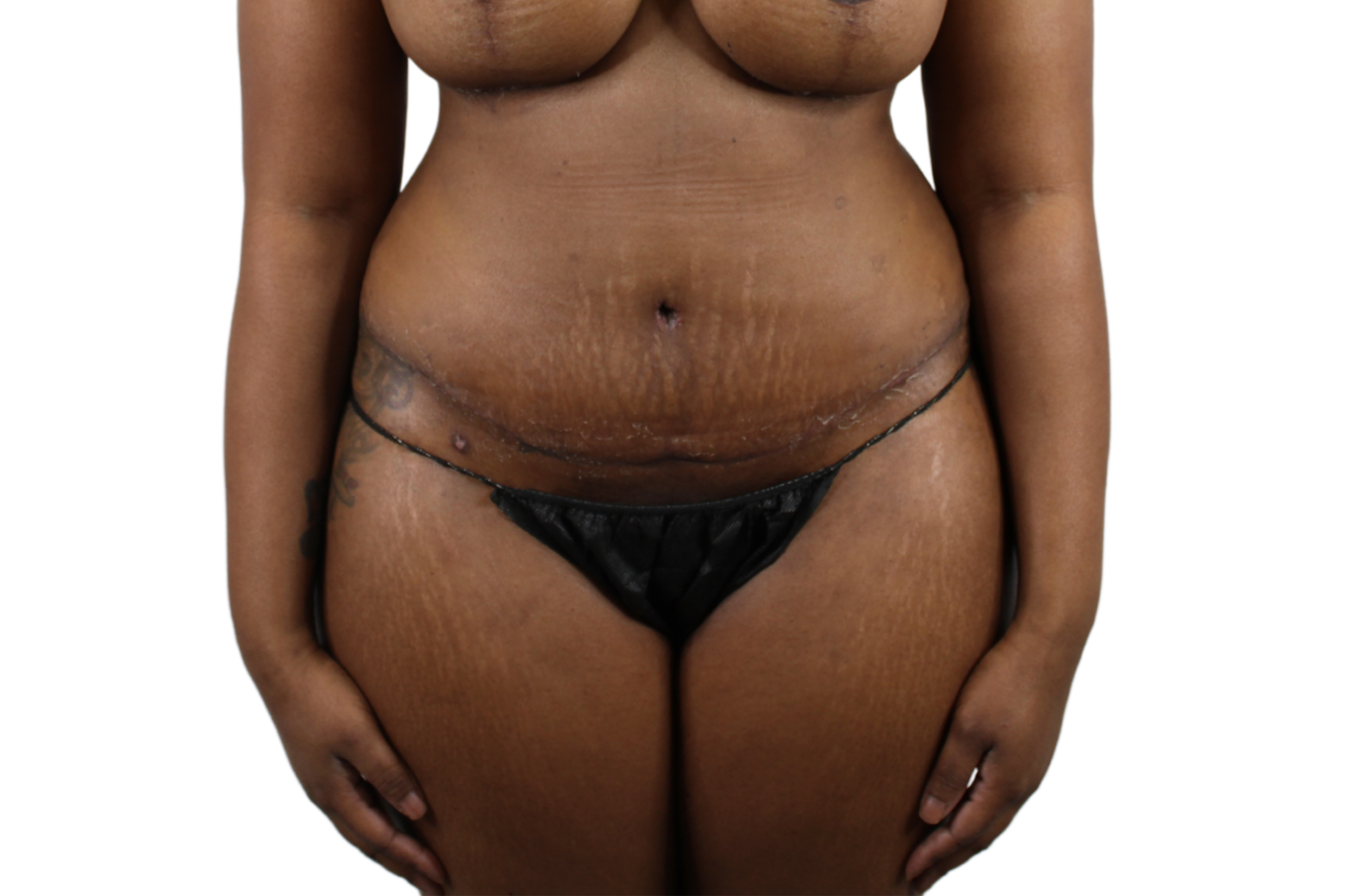 Admire Plastic Surgery tummy tuck after — Gilbert, AZ