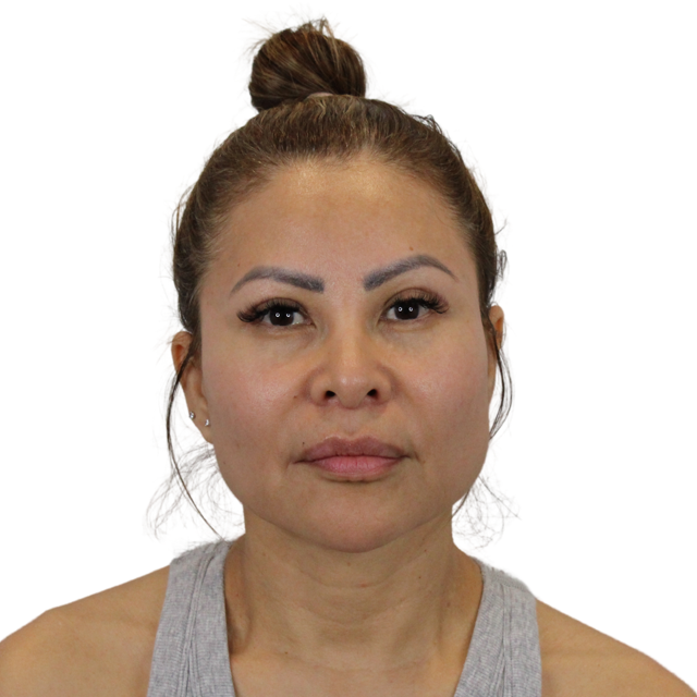 Neck Lift after at Admire Plastic Surgery in Gilbert, AZ