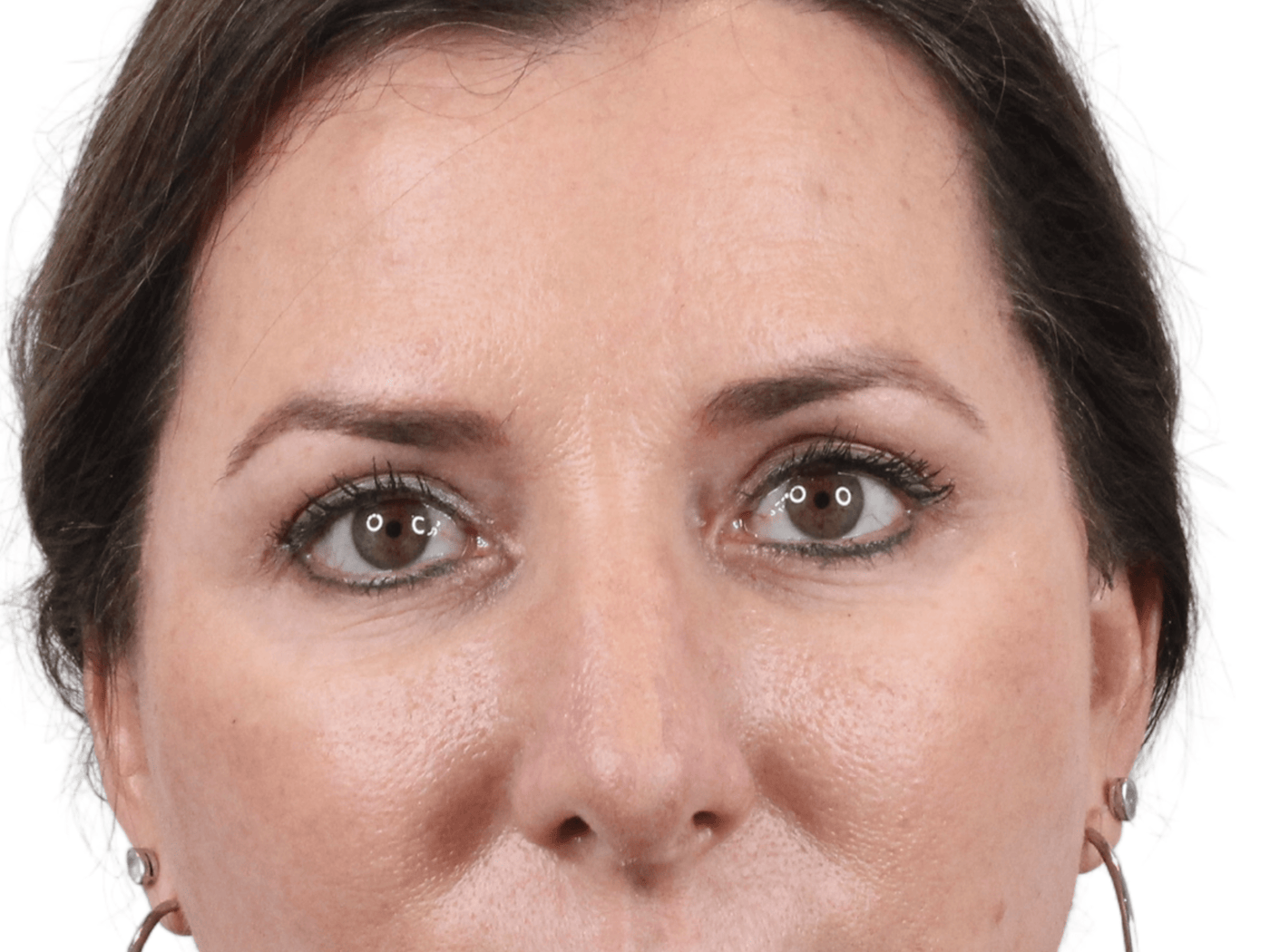 Admire Plastic Surgery blepharoplasty after — Gilbert, AZ