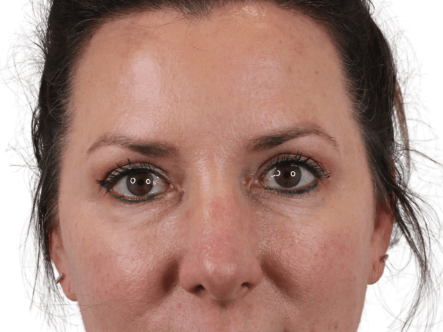 Blepharoplasty before at Admire Plastic Surgery in Gilbert, AZ
