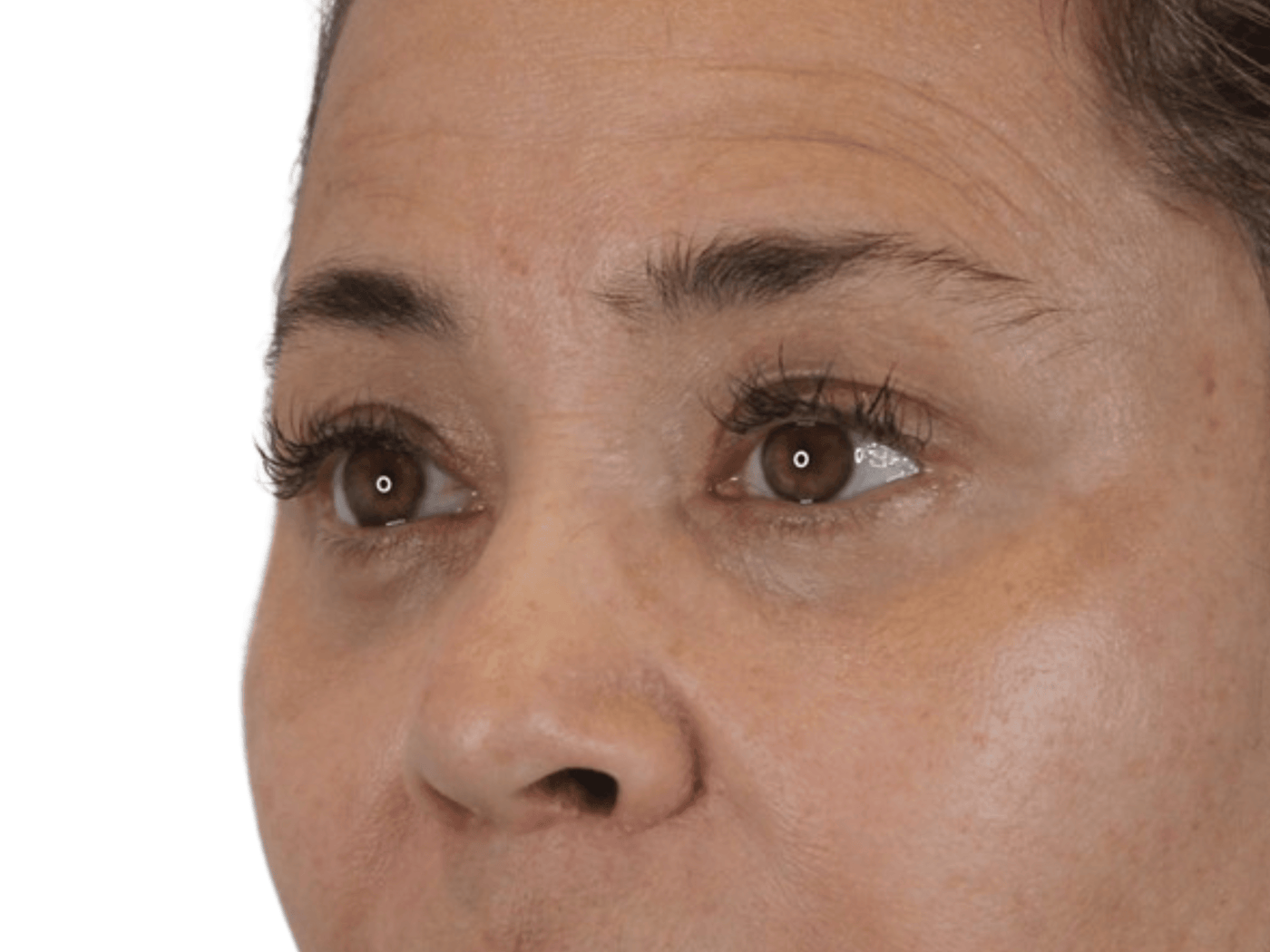 Admire Plastic Surgery blepharoplasty after — Gilbert, AZ