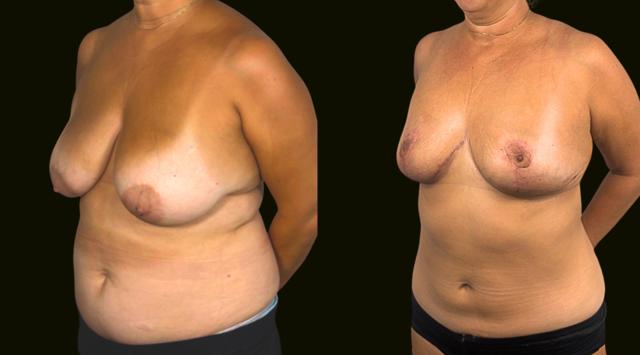 Breast Reduction result at Sanam Zahedi, MD - Zahedi Plastic Surgery in Aventura, FL