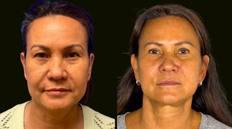 Sanam Zahedi, MD - Zahedi Plastic Surgery neck lift result — Aventura, FL