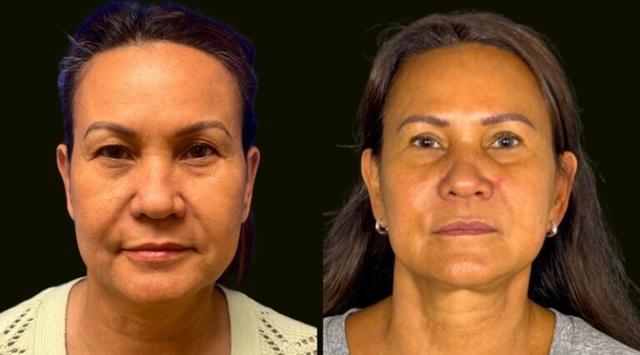 Neck Lift result at Sanam Zahedi, MD - Zahedi Plastic Surgery in Aventura, FL