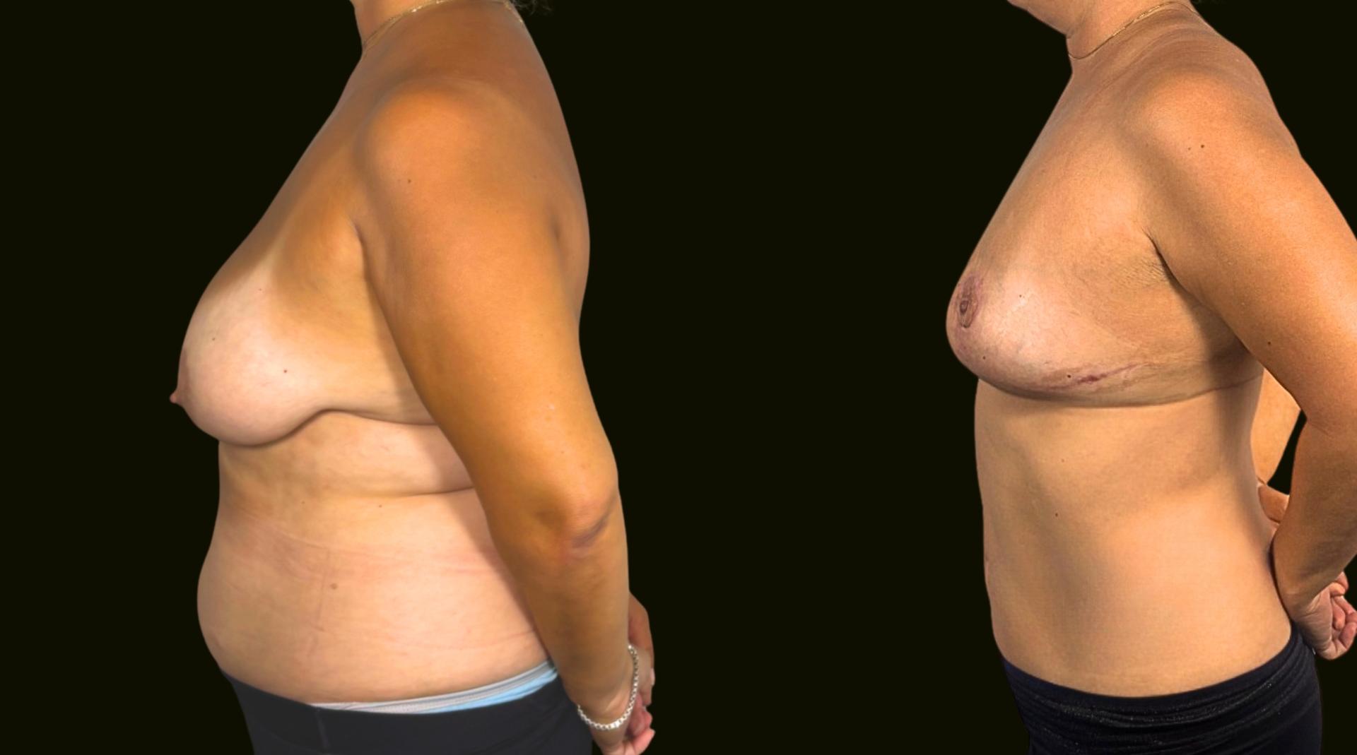 Sanam Zahedi, MD - Zahedi Plastic Surgery breast reduction result — Aventura, FL