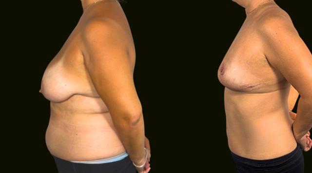 Breast Reduction result at Sanam Zahedi, MD - Zahedi Plastic Surgery in Aventura, FL