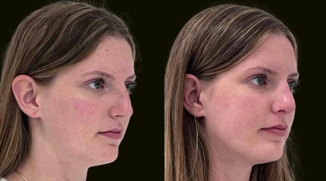 Rhinoplasty result at Sanam Zahedi, MD - Zahedi Plastic Surgery in Aventura, FL