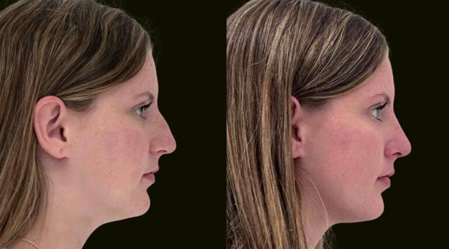 Rhinoplasty result at Sanam Zahedi, MD - Zahedi Plastic Surgery in Aventura, FL