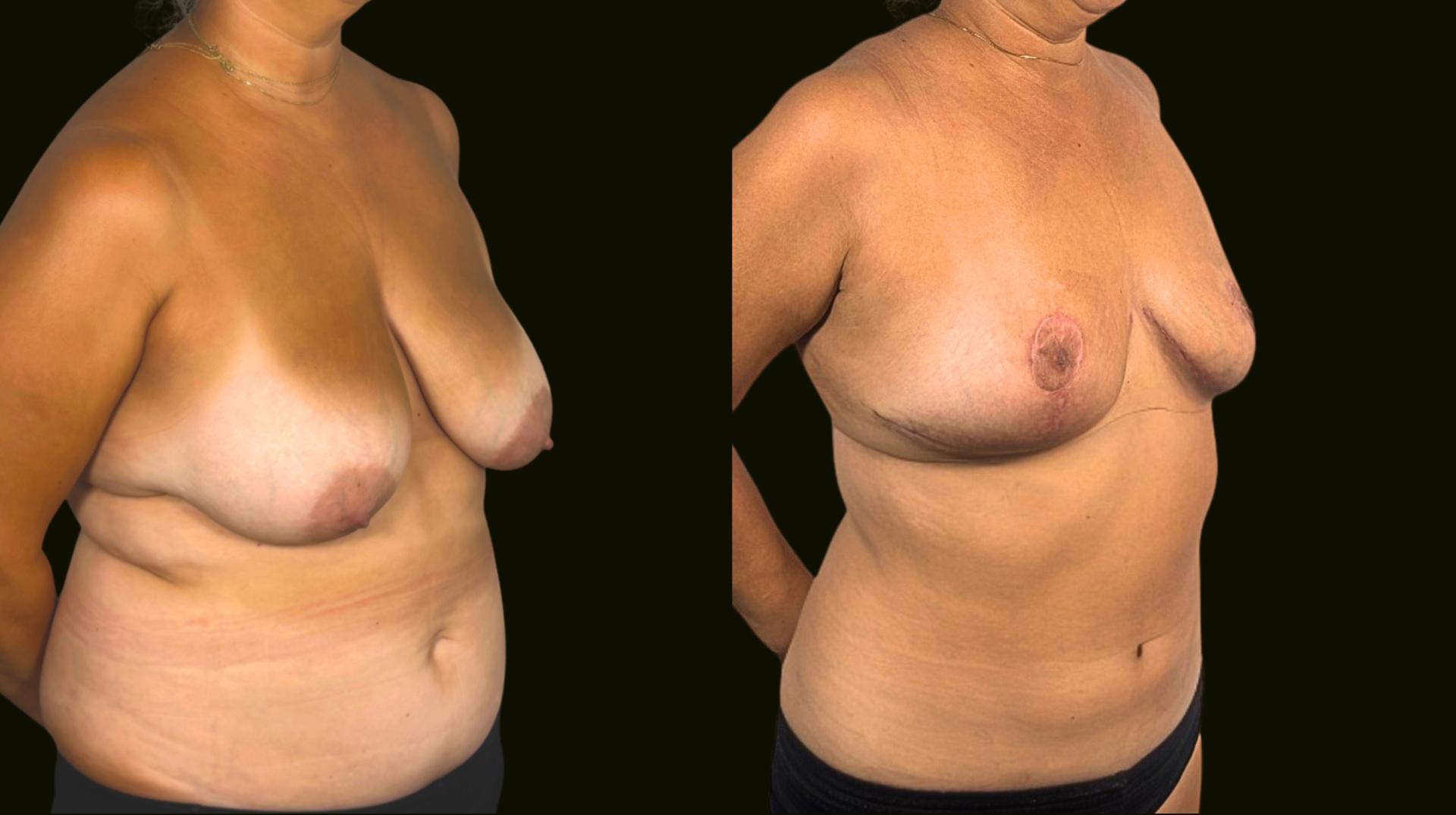 Sanam Zahedi, MD - Zahedi Plastic Surgery breast reduction result — Aventura, FL