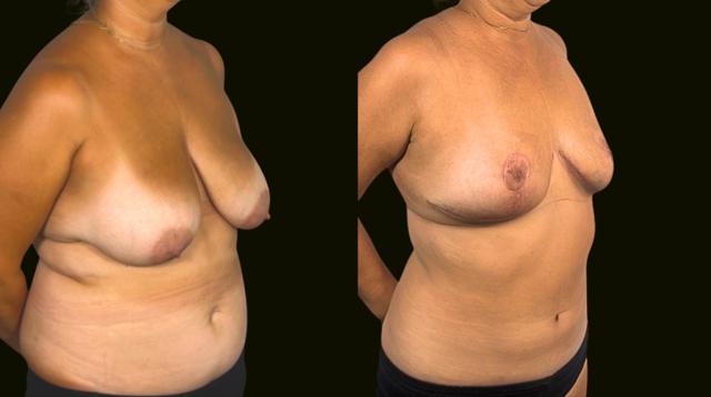Breast Reduction result at Sanam Zahedi, MD - Zahedi Plastic Surgery in Aventura, FL