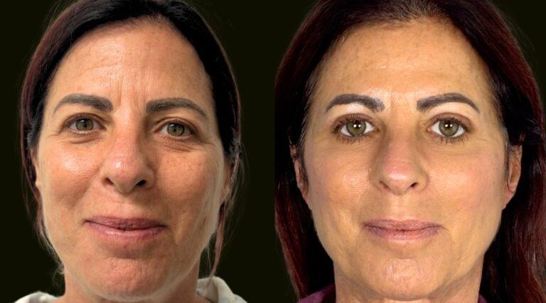 Sanam Zahedi, MD - Zahedi Plastic Surgery eyelid lift result — Aventura, FL