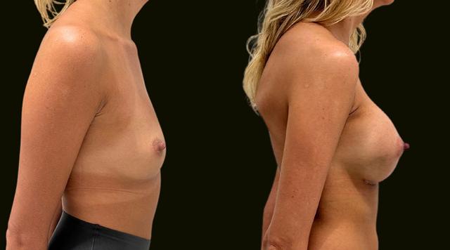 Breast Augmentation result at Sanam Zahedi, MD - Zahedi Plastic Surgery in Aventura, FL