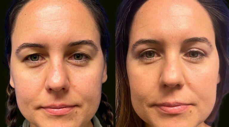 Sanam Zahedi, MD - Zahedi Plastic Surgery eyelid lift result — Aventura, FL