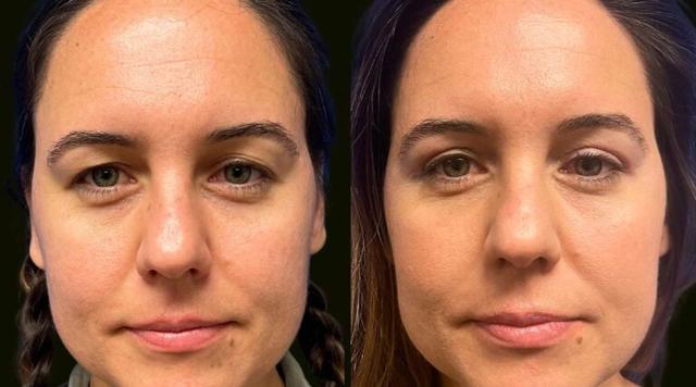 Blepharoplasty result at Sanam Zahedi, MD - Zahedi Plastic Surgery in Aventura, FL