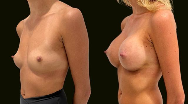 Breast Augmentation result at Sanam Zahedi, MD - Zahedi Plastic Surgery in Aventura, FL