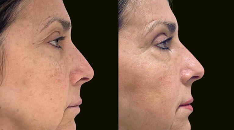 Sanam Zahedi, MD - Zahedi Plastic Surgery blepharoplasty result — Aventura, FL