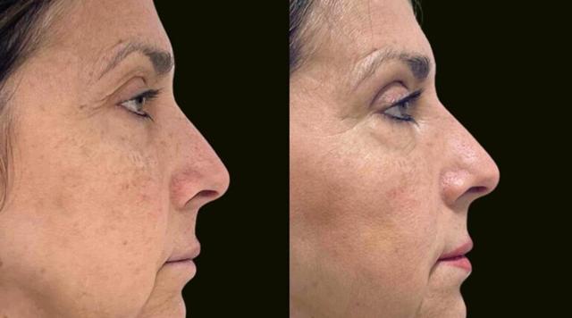 Blepharoplasty result at Sanam Zahedi, MD - Zahedi Plastic Surgery in Aventura, FL