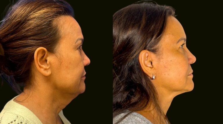 Sanam Zahedi, MD - Zahedi Plastic Surgery facelift result — Aventura, FL