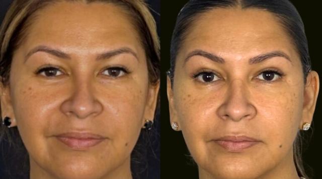 Blepharoplasty result at Sanam Zahedi, MD - Zahedi Plastic Surgery in Aventura, FL