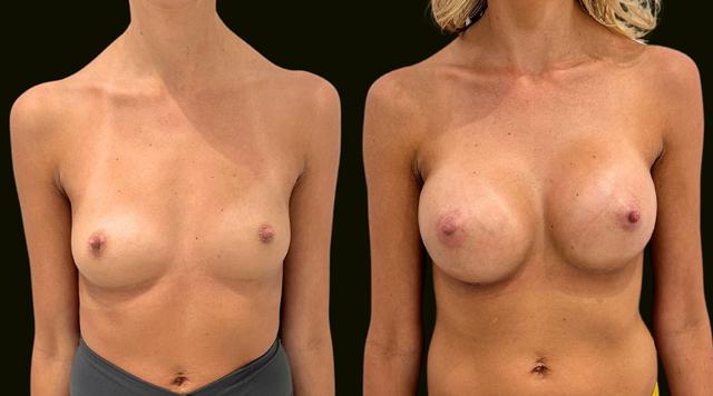 Breast Augmentation result at Sanam Zahedi, MD - Zahedi Plastic Surgery in Aventura, FL