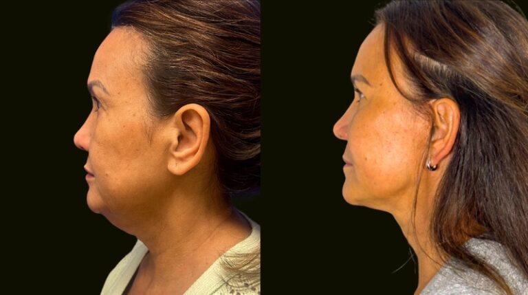 Sanam Zahedi, MD - Zahedi Plastic Surgery neck lift result — Aventura, FL