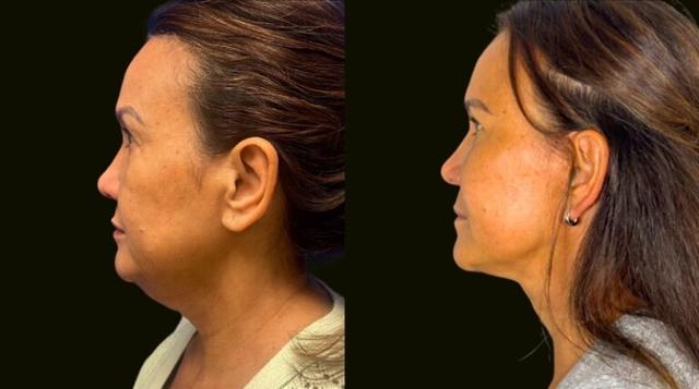 Neck Lift result at Sanam Zahedi, MD - Zahedi Plastic Surgery in Aventura, FL
