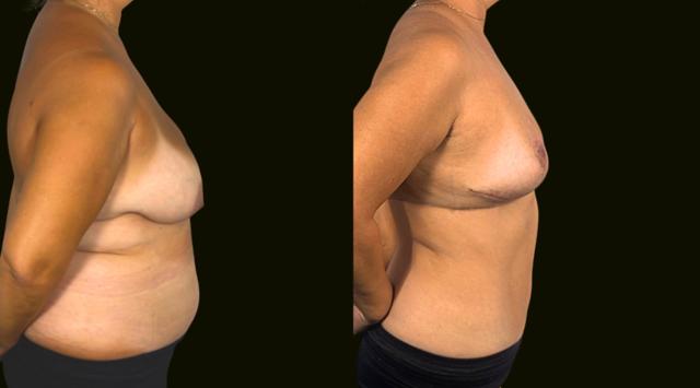 Breast Reduction result at Sanam Zahedi, MD - Zahedi Plastic Surgery in Aventura, FL