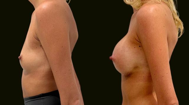 Breast Augmentation result at Sanam Zahedi, MD - Zahedi Plastic Surgery in Aventura, FL