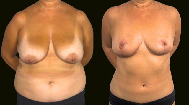 Breast Reduction result at Sanam Zahedi, MD - Zahedi Plastic Surgery in Aventura, FL