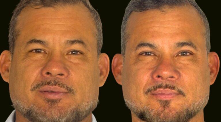Sanam Zahedi, MD - Zahedi Plastic Surgery eyelid lift result — Aventura, FL