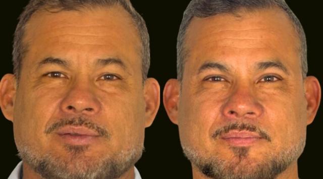 Blepharoplasty result at Sanam Zahedi, MD - Zahedi Plastic Surgery in Aventura, FL