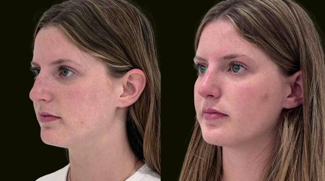 Rhinoplasty result at Sanam Zahedi, MD - Zahedi Plastic Surgery in Aventura, FL