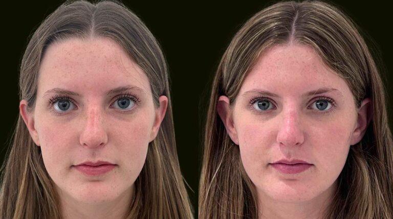 Sanam Zahedi, MD - Zahedi Plastic Surgery rhinoplasty result — Aventura, FL