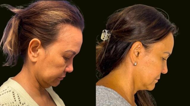 Facelift result at Sanam Zahedi, MD - Zahedi Plastic Surgery in Aventura, FL