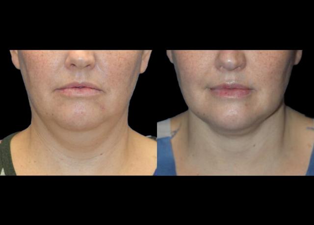 Neck Lift result at Evolve Your Life in Chicago, IL