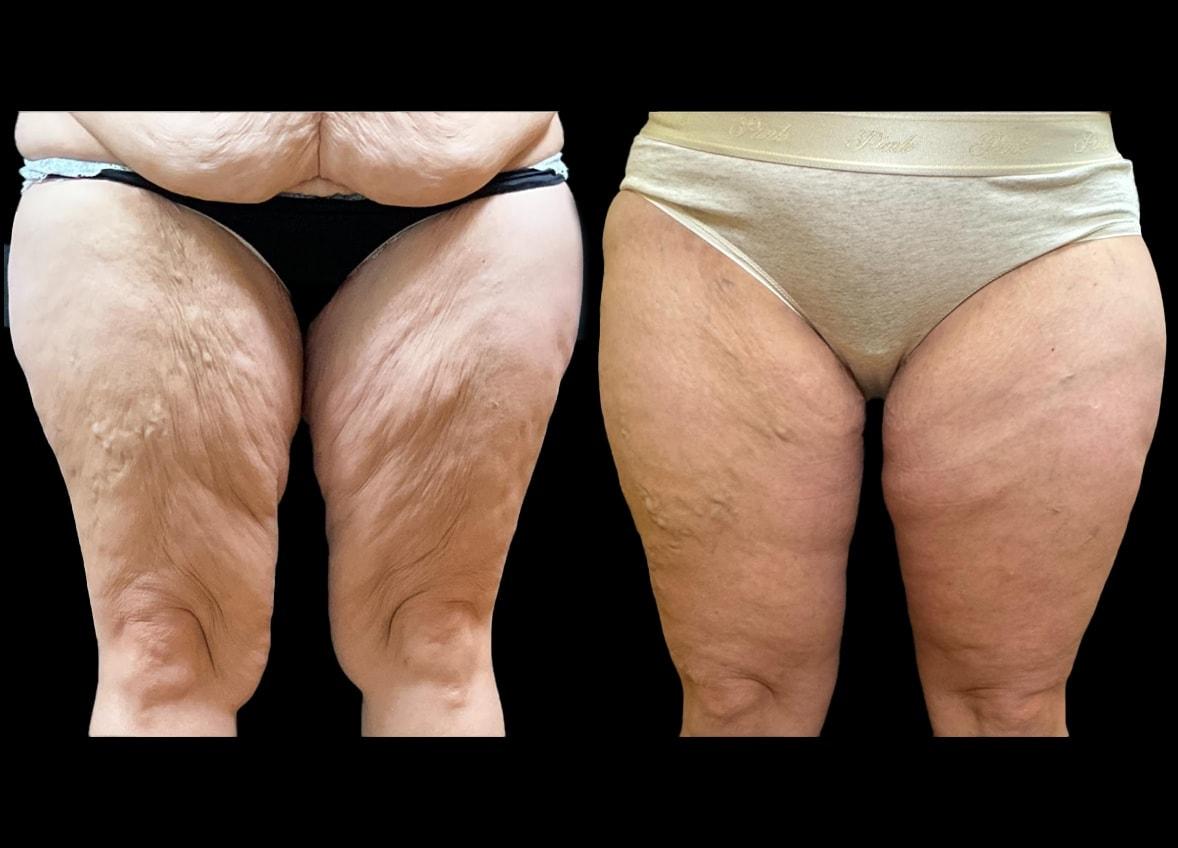 Evolve Your Life thigh lift result — Chicago, IL