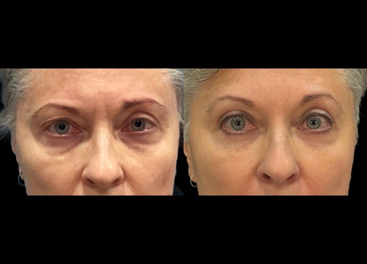 Evolve Your Life eyelid lift result — Chicago, IL