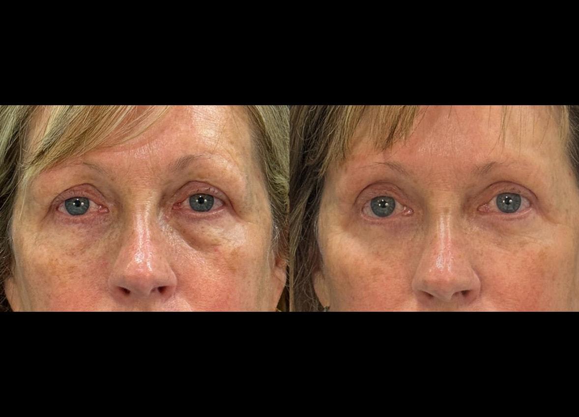Evolve Your Life eyelid lift result — Chicago, IL