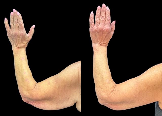 Arm Lift result at Evolve Your Life in Chicago, IL