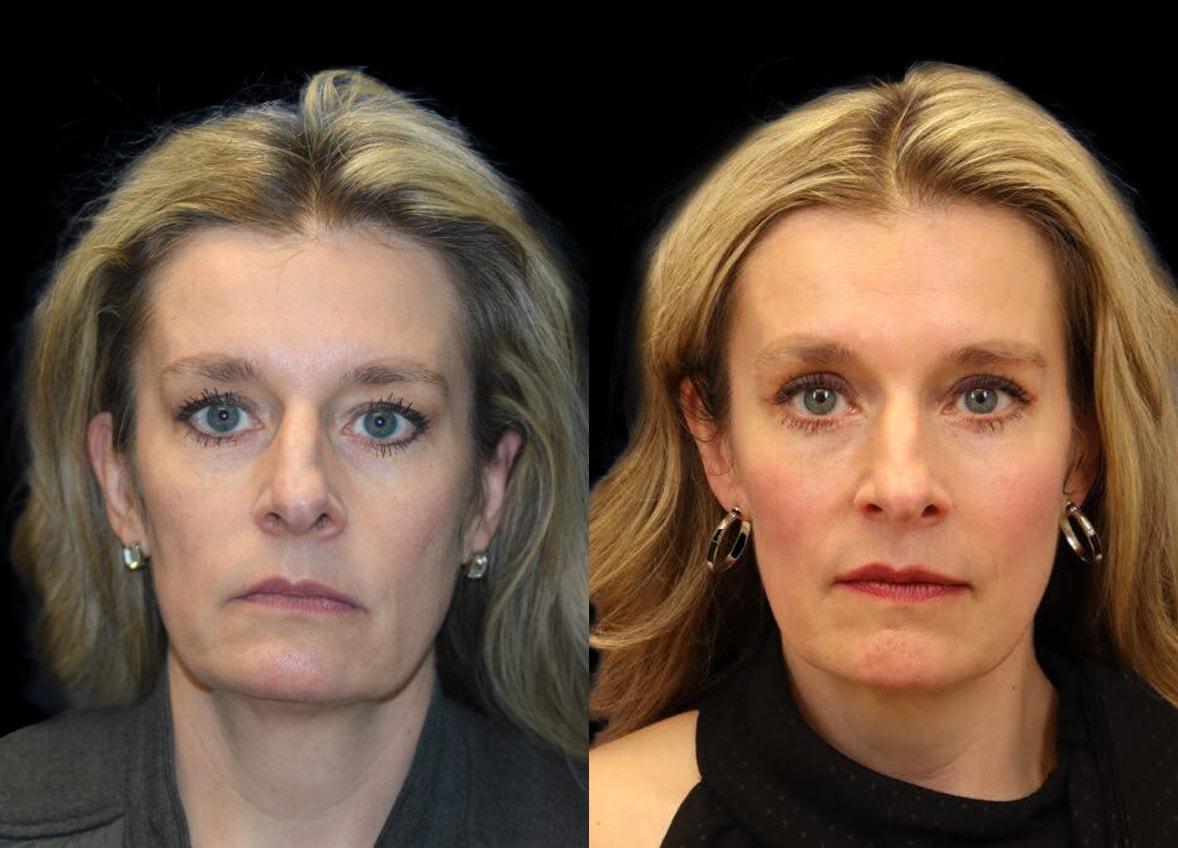 Evolve Your Life eyelid lift result — Chicago, IL