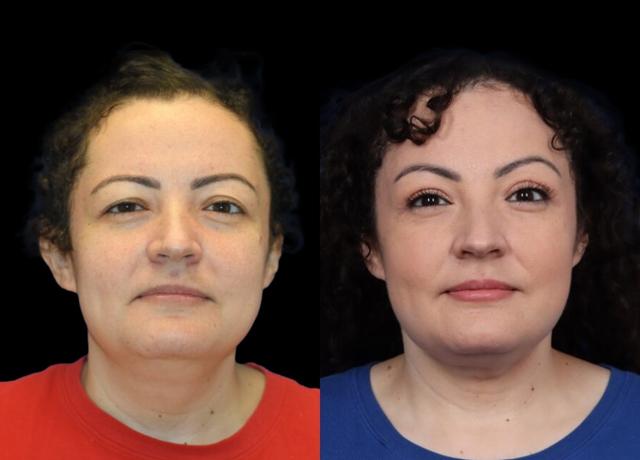 Brow Lift result at Evolve Your Life in Chicago, IL