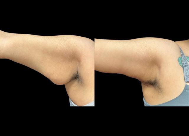 Arm Lift result at Evolve Your Life in Chicago, IL