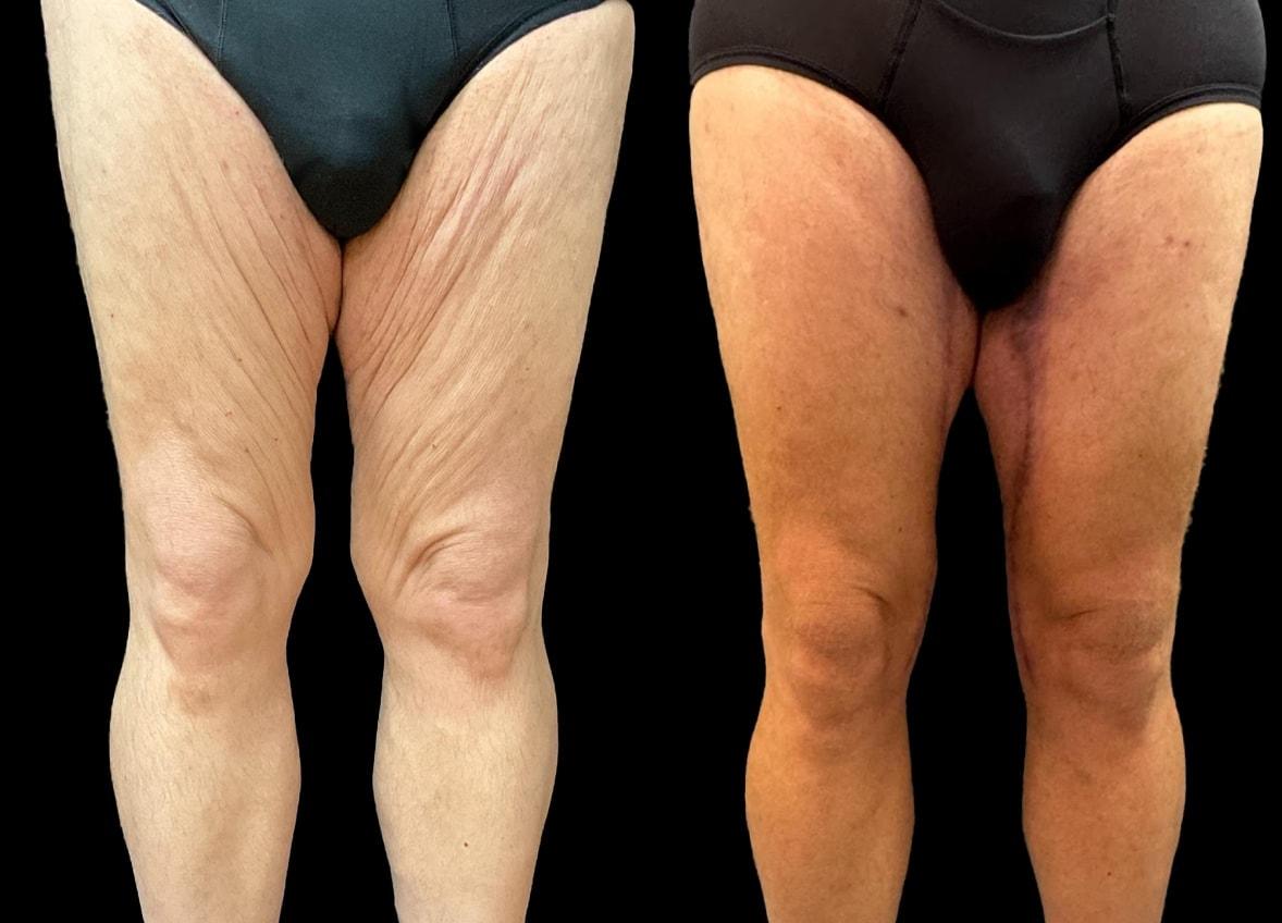 Evolve Your Life thigh lift result — Chicago, IL