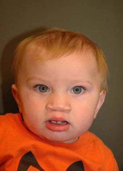 Idaho Cleft and Craniofacial Surgery after — Boise, ID
