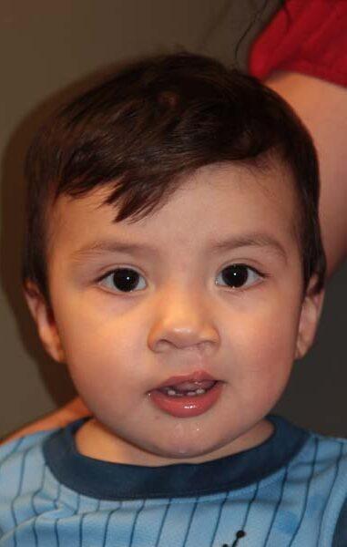Idaho Cleft and Craniofacial Surgery after — Boise, ID
