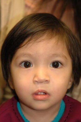 Idaho Cleft and Craniofacial Surgery after — Boise, ID