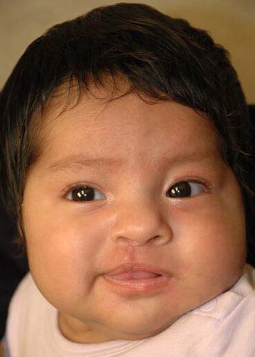 Idaho Cleft and Craniofacial Surgery after — Boise, ID