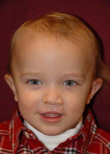 Idaho Cleft and Craniofacial Surgery after — Boise, ID