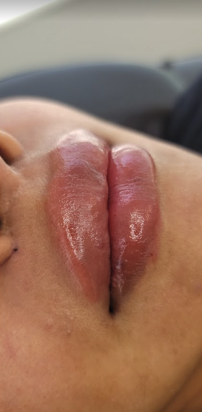 Renewal Aesthetics and Sexual Wellness lip filler after — Draper, UT