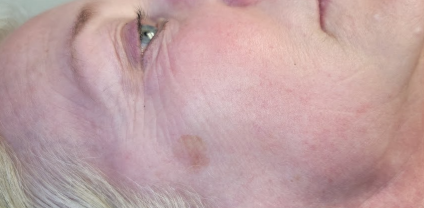 Renewal Aesthetics and Sexual Wellness result — Draper, UT